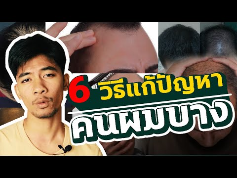 6 วิธีแก้ปัญหาคนผมบาง (ตัดทรงไหนได้บ้าง)