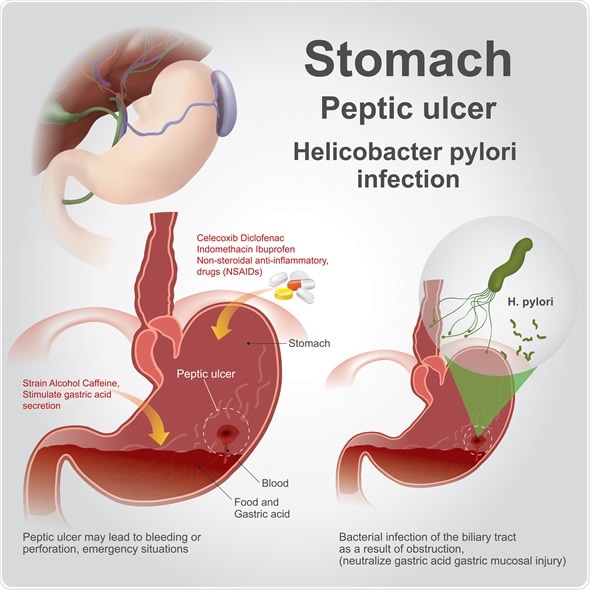 Living With Peptic Ulcer Disease