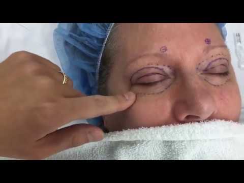 Upper and Lower Eyelid Lift - Before and After -  Dr. Anthony Youn