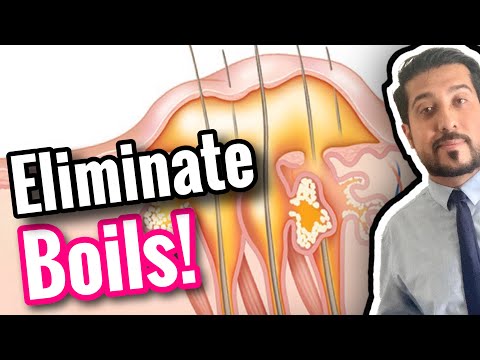 5 Quick Ways to GET RID OF Boils on Skin | How to Treat a Boil Fast