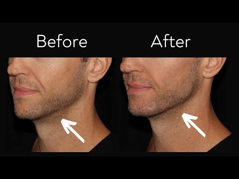 Define Your Jawline Without Surgery!