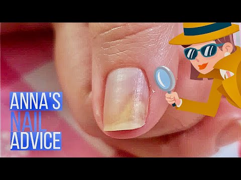 Nail Separation | Causes | Early Treatment of Onycholysis [Anna's Nail Advice]