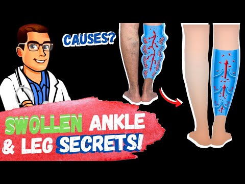 Edema: Swollen Feet, Swollen Ankles & Swollen Legs [FIX Them FAST!]